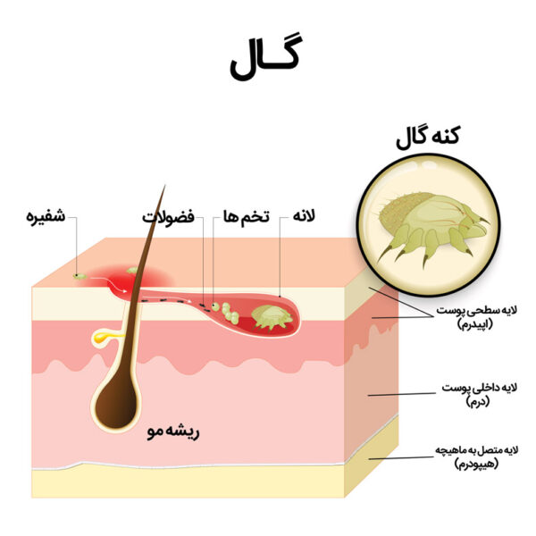 گال چیست؟ 0 تا 100 را بدانید – دکتر گال