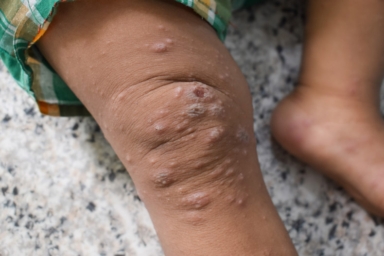 پای کودک مبتلا به گال با عفونت ثانویه