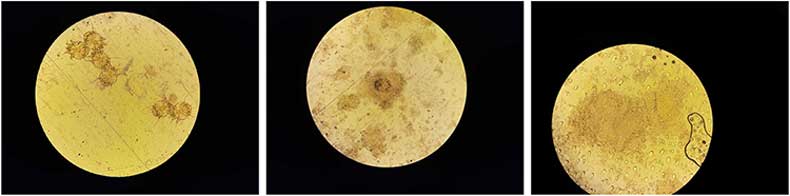 نمونه میکروسکوپی پوست دارای گال